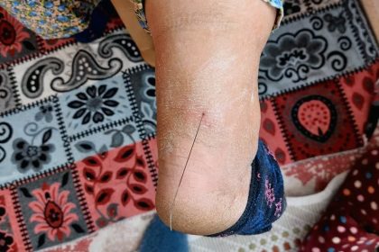 bacağında tel çıkan kadın