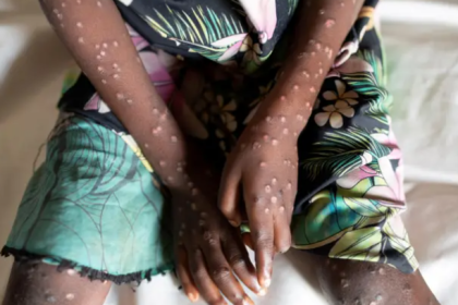 maymun çiçeği virüsü belirtileri maymun çiçeği belirtileri maymun çiçeği nasıl bulaşır maymun cicegi virusu maymun cicegi