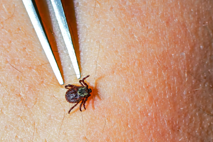 kene vakaları, kene belirtileri, kene nasıl çıkartılır, keneden korunma, kene ısırma belirtileri